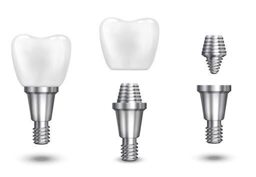 Titanium Dental Implants